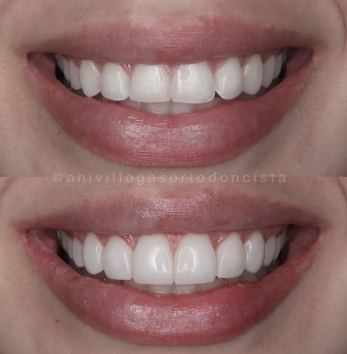 Transformación Diseño de Sonrisa
