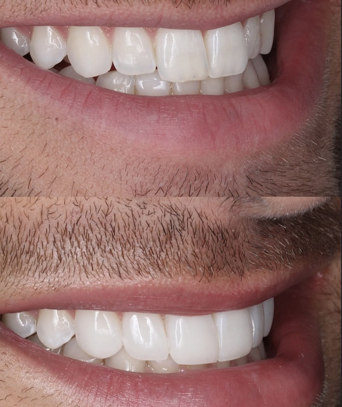 Transformación Microdiseño de sonrisa